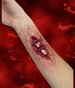 Broken Bone Fracture Moulage